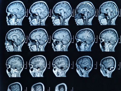 entrer dans le cerveau » pour soigner l'Alzheimer ? | Orthophonie